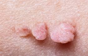 Image result for Skin Tag