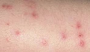 Flea bites vary in intensity, depending upon the affected individual and their degree of sensitization. How To Tell If I Have Bed Bugs Baltimore Bed Bug Exterminator