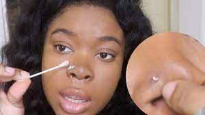 To Get Rid Of A Nose Piercing Bump Fast Keloid Youtube