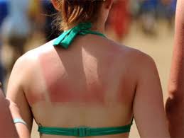 But how bad is one sunburn, really? Cdc Skin Cancer Risks For Young Adults On The Rise Driven By Sunburn And Indoor Tanning Cbs News