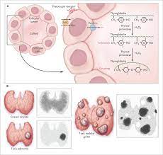 Radioiodine Therapy For Hyperthyroidism Nejm