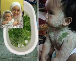 Tapi dia boleh kembali cantik semula. Chickenpox Selain Guna Losyen Dari Klinik Ibu Ni Kongsi Petua Lain Untuk Cepat Sembuh Keluarga