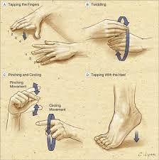 Image result for Rest Tremor