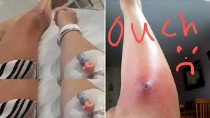 Your bites might be caused by bedbugs if you woke up with them. Mum Almost Died From Spider Bite After She Contracted Sepsis Metro News