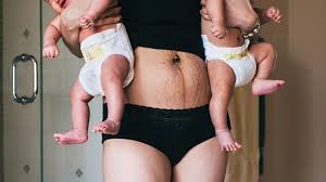 The amazing natural formula of vitamins, plants&herbs that completely reduce belly fat Loose Skin After Pregnancy Pictures Treatments And Timeline