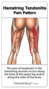 Tendinopathy Of The Hamstring Hamstring Muscles Hamstring Tendonitis Hamstring Cramps