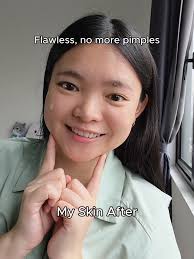 Effective Acne Serum for Clear Skin Results