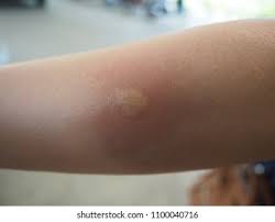 Image result for ant bite