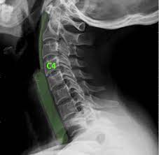What's the average insurance settlement for neck and back injuries? Neck Injury Settlement Amounts Updated 2021