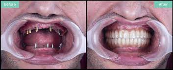 Maybe you would like to learn more about one of these? Dental Implants Cannock Teeth Implant Costs Treatments