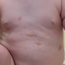 Image result for Urticaria pigmentosa children