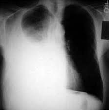 Pleural Effusion Diagnosis Treatment And Management Abstract Europe Pmc