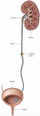 Double J Stent Placement Patient Information
