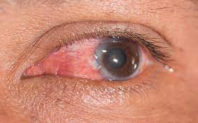 How To Get Rid Of Red Eyes - Top 5 Causes
