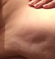 The american cancer society lists multiple signs and symptoms beyond lumps and hard masses: Mom S Viral Post Shows Rare Breast Cancer Symptom All Women Should Know About