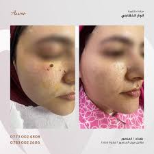 حالة رفه شامة لمراجعتي الحلوة🥰بعيادة #الدكتورة_أنوار_الخفاجي. للحجز  والاستفسار 📞 07730024808