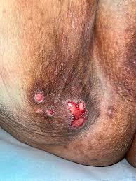 Image result for genital herpes