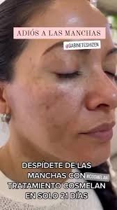 Remedios Para Manchas en la Piel