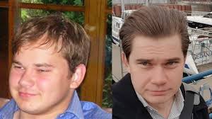 What is microneedling, and what are the benefits? Can Derma Rolling Cause Some Temporary Shedding Youtube