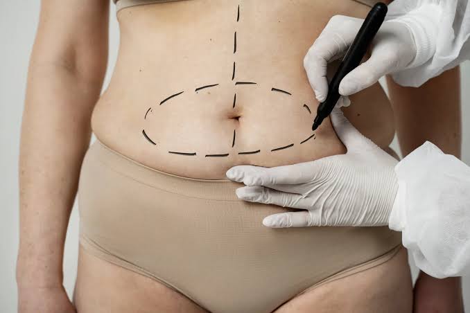 Tummy Tuck in Dubai | Belly Tuck & Abdominoplasty Surgery
