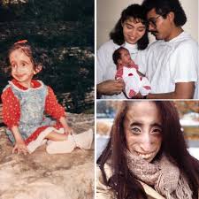 Lizzie Velasquez rare medical condition
