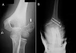 The medial epicondyle of the humerus is an epicondyle of the humerus bone of the upper arm in humans. Ap View X Ray Of The Left Elbow Showing A Displaced Fracture Of The Download Scientific Diagram