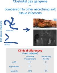 Most modern cars include a knock sensor which regulates the ignition timing to achieve optimal combustion efficiency. Clostridial Gas Gangrene A Rare But Deadly Infection Case Series And Comparison To Other Necrotizing Soft Tissue Infections Leiblein 2020 Orthopaedic Surgery Wiley Online Library