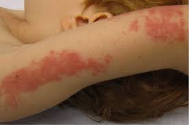 5 year old boy with chicken pox (photo credit: Kayap Punca Simptom Rawatan Dan Pantang Larang Jiwasihat