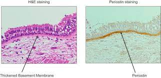 Overview anterior basement membrane dystrophy (abmd; Involvement Of Periostin In Thickness Of Basement Membrane In Bronchial Download Scientific Diagram
