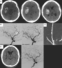 Image result for Cerebral Subcortex