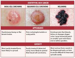 Skin Cancer Signs Self Checks May Help You Avoid Deadly