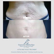 Diately after rf treatments, which induces new. Vivace Plus Body Greenwich Medical Spa Greenwich Ct Westport Ct Scarsdale Ny