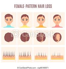 Her scalp is almost bald, she just has some longer strands here and there. Woman Before And After Hair Loss Treatment In Front And Top View Female Pattern Hair Loss Set Stages Of Baldness In Women Canstock