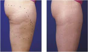 Collagen also thickens the dermis while making it more elastic, firm, and smooth, which in turn reduces the appearance of cellulite lumps. Treatment For Cellulite Sciencedirect