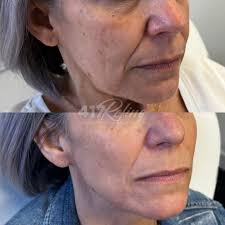 Before and after… One tox booster VI peel! 🤩 What is a tox booster VI  peel? It is simply receiving your tox injections at the same time as your  VI peel. The