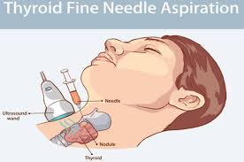 Image result for Multinodular Goiter