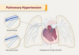 Image result for Hypertension