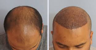 تكلفة ومراكز زراعة الشعر في الاسكندرية بشرة وشعر