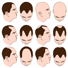 Does Wearing A Hat Really Make You Go Bald Futurederm