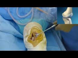 Une incision est réalisée au niveau de la partie antérieure du genou. Prothese Uni Compartimentale Du Genou Puc Dr Catimel Clinique Du Pre Le Mans Youtube