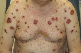 Image result for Pemphigoid