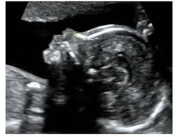 Fetal Nasal Bone Hypoplasia In The Second Trimester And Risk