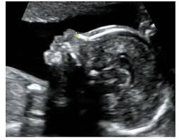 fetal nasal bone hypoplasia in the second trimester and risk