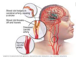 Dear heril, benturan pada kepala dapat menimbulkan trauma atau cedera, serta perdarahan pada jaringan otak sehingga akhirnya timbul gangguan fungsi otak baik. Etiologi Strok My Stroke Hospital