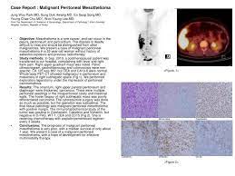 Find a mesothelioma specialist top treatment centers Ppt Case Report Malignant Peritoneal Mesothelioma Powerpoint Presentation Id 3889303
