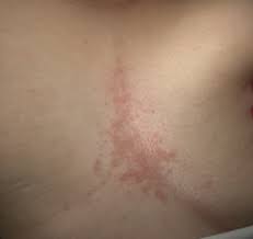A cotton pad may also be used between the lower breast area and the surrounding skin as you are wearing clothes. Redness Between Breasts With Pics Babycenter
