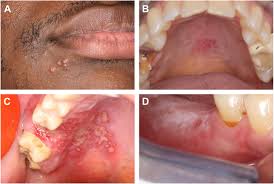 Image result for Oral herpes roof of mouth