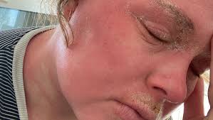 Fundraiser by Chloe Chapman : Chloe's Skin Healing Journey