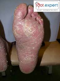 Image result for Ichthyosis