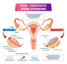 Polycystic Ovary Syndrome Pcos Awareness Mo Ceufast Com Blog
